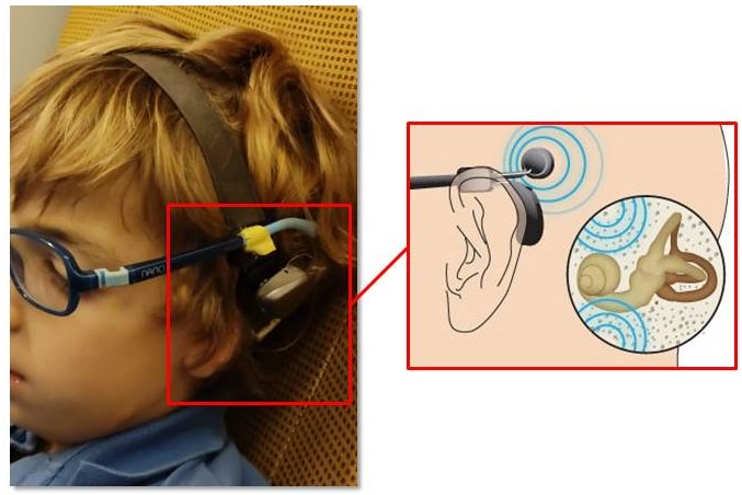 Aparato auditivo necesario para personas que sufren el Síndrome de Treacher-Collins