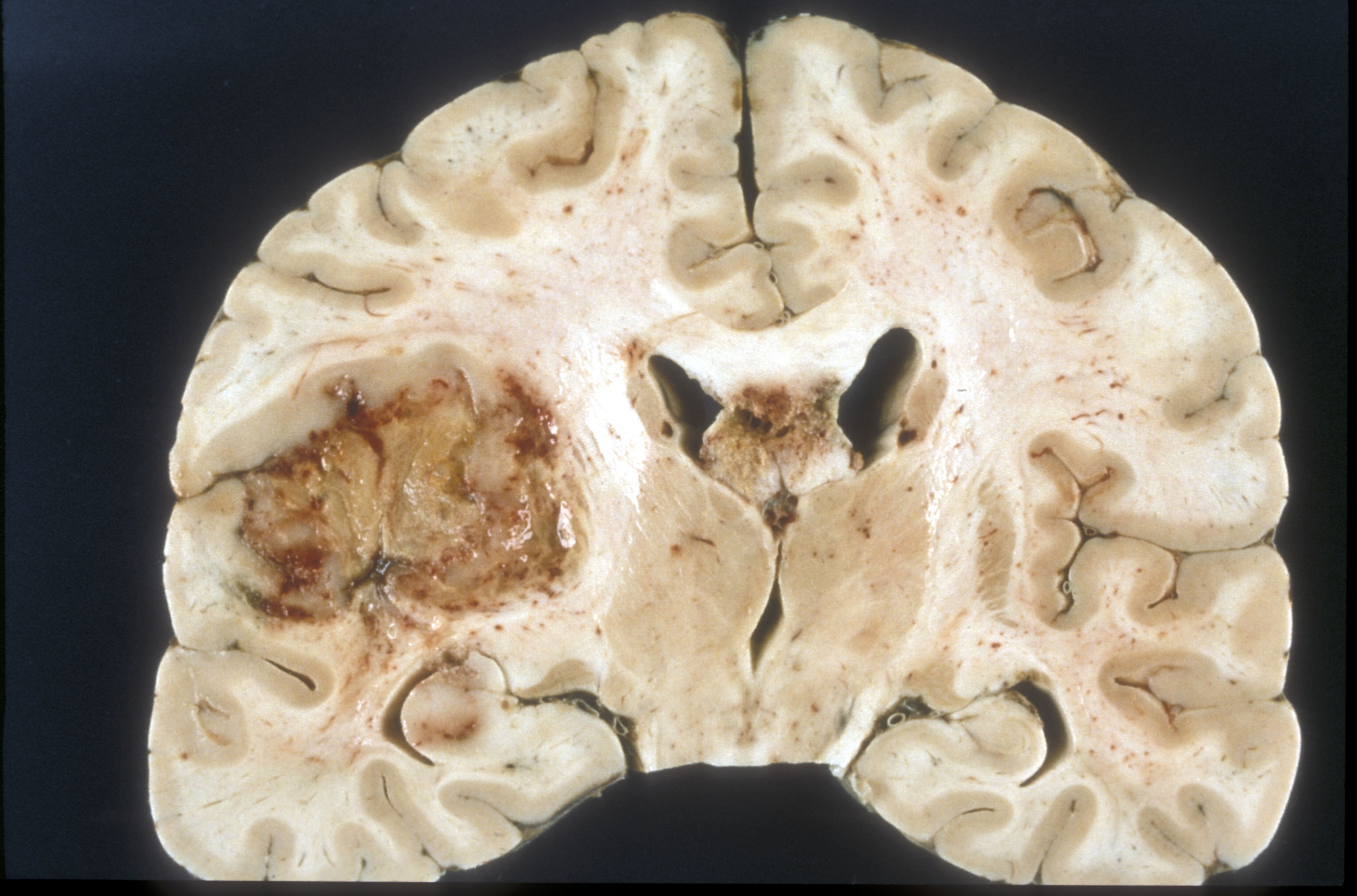 Glioblastoma blanco en sección transversal de cerebro humano a vista macroscópica.