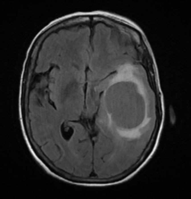 Resonancia magnética sagital de cerebro humano - se aprecia un glioblastoma multiforme. Colocar al lado de la imagen anterior.