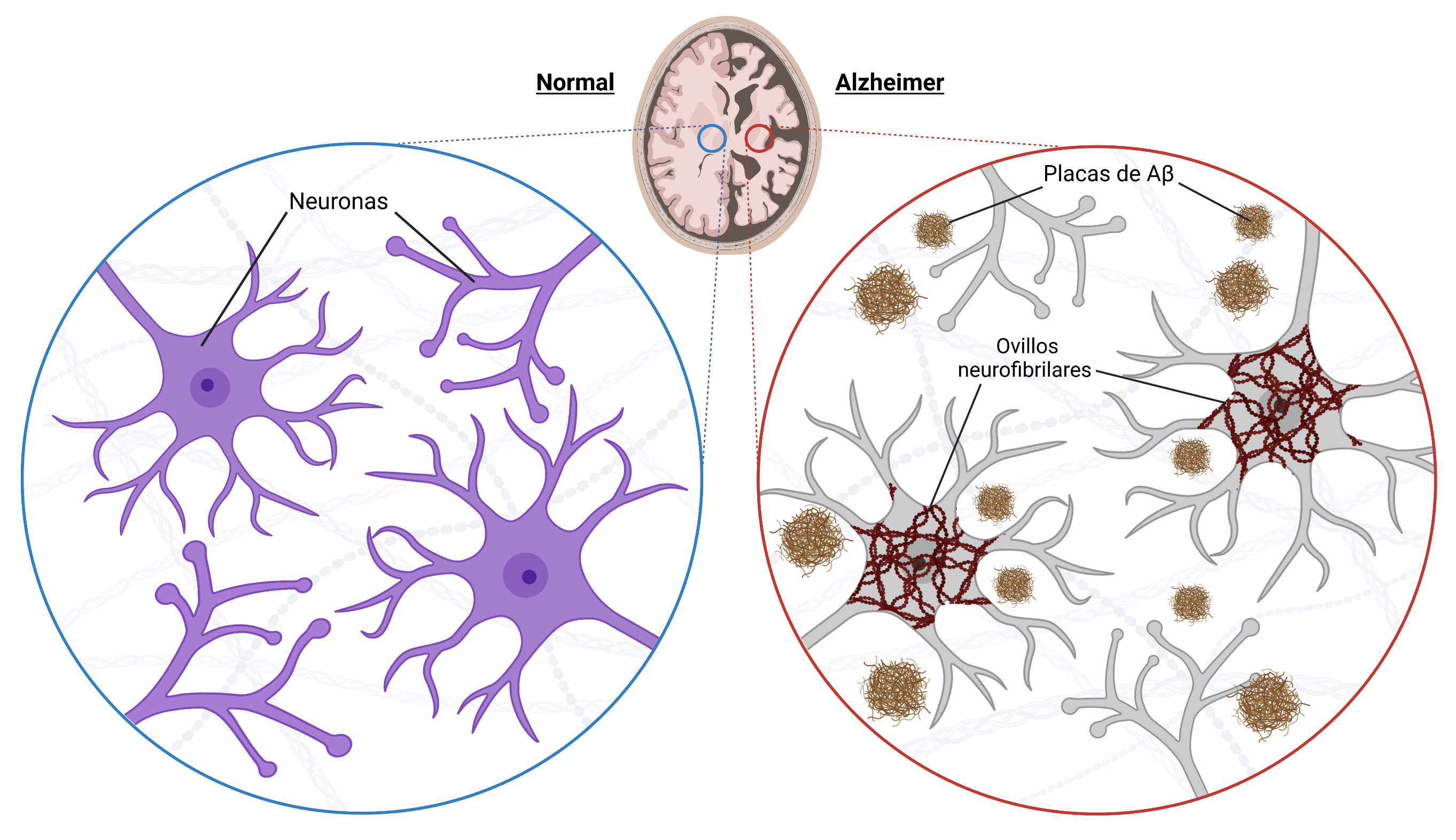 Representación gráfica de las diferencias entre un cerebro sano (derecha) y un cerebro de una persona con enfermedad de Alzheimer (izquierda). Dada la muerte de las neuronas en las personas enfermas, el cerebro de los afectados pierde volumen en comparación con el de las personas sanas.