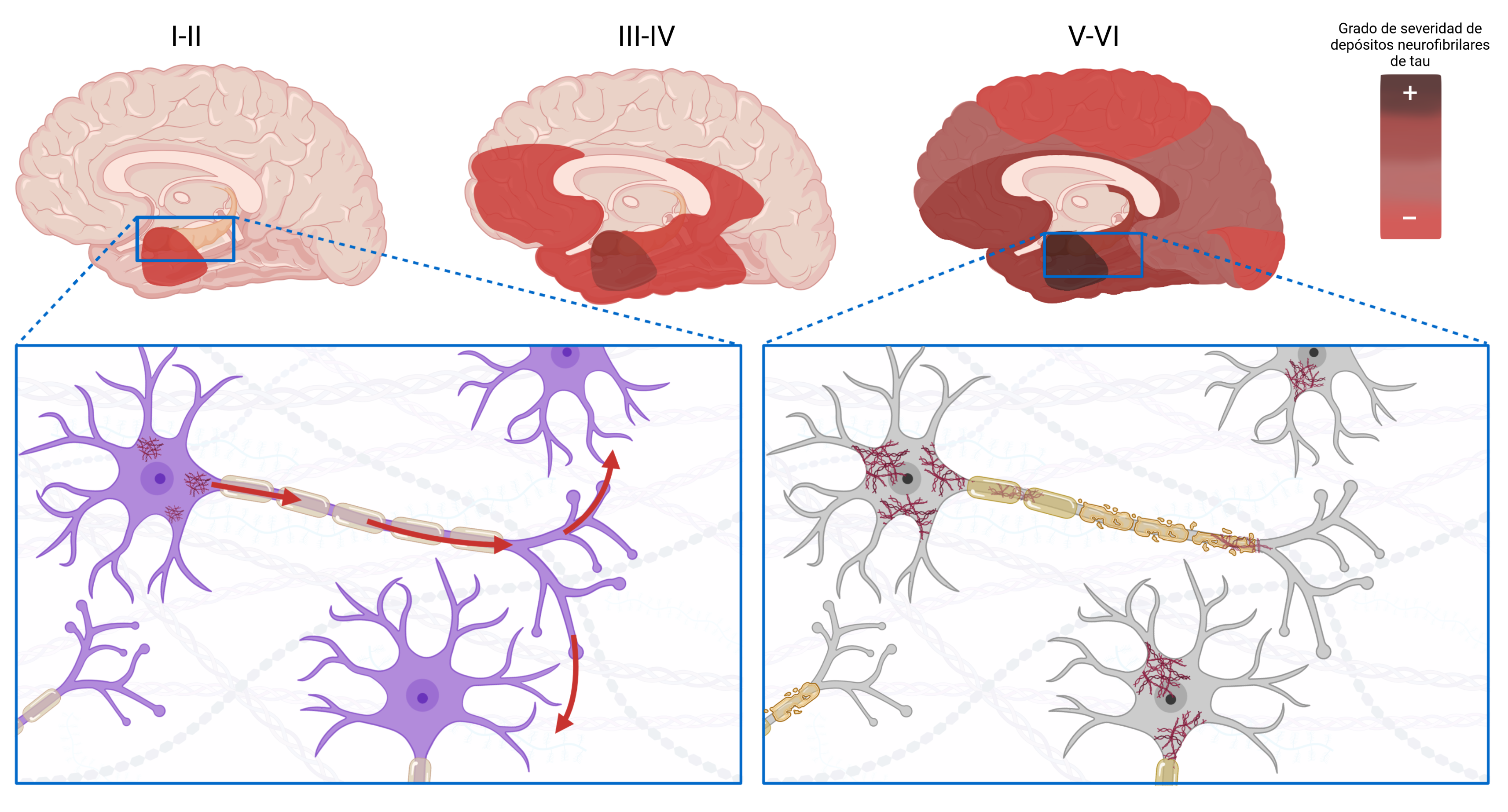 En los estadios de Braak I-II, la acumulación de la proteína tau defectuosa (depósitos neurofibrilares) es leve y comienza en una región determinada del sistema nervioso; en los estadios de Braak III-IV, los acúmulos comienzan a ser más graves y, gracias a la capacidad de la proteína defectuosa de llegar de unas neuronas a otras y de alterar proteínas tau sanas, se disemina por otras regiones; finalmente, en los estadios Braak V-VI, los acúmulos de tau abarcan todo el sistema nervioso.