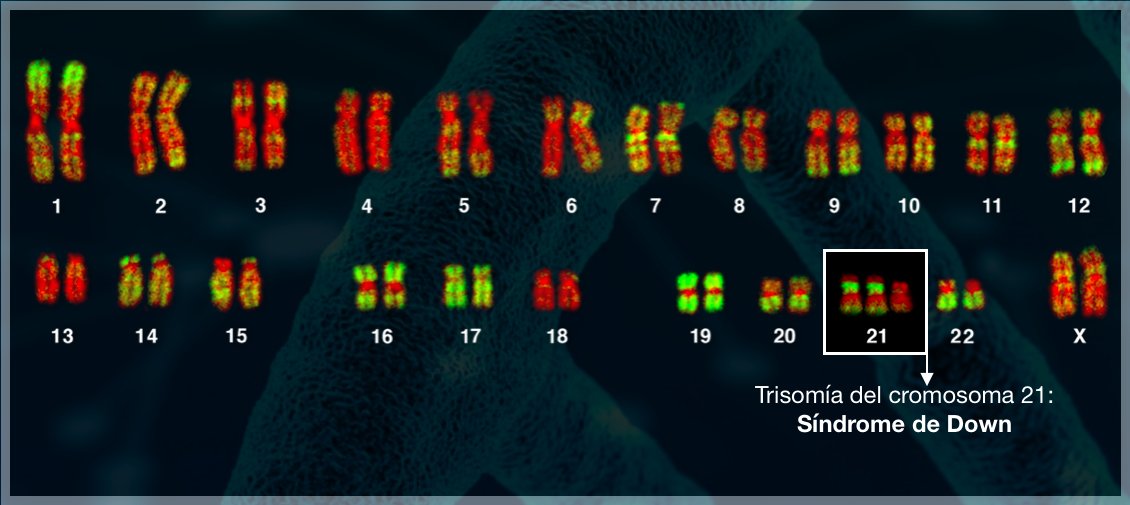 Siguiendo el ejemplo anterior, mostramos un cariotipo si tuviera una trisomía del cromosoma 21 (recuadrado en negro).