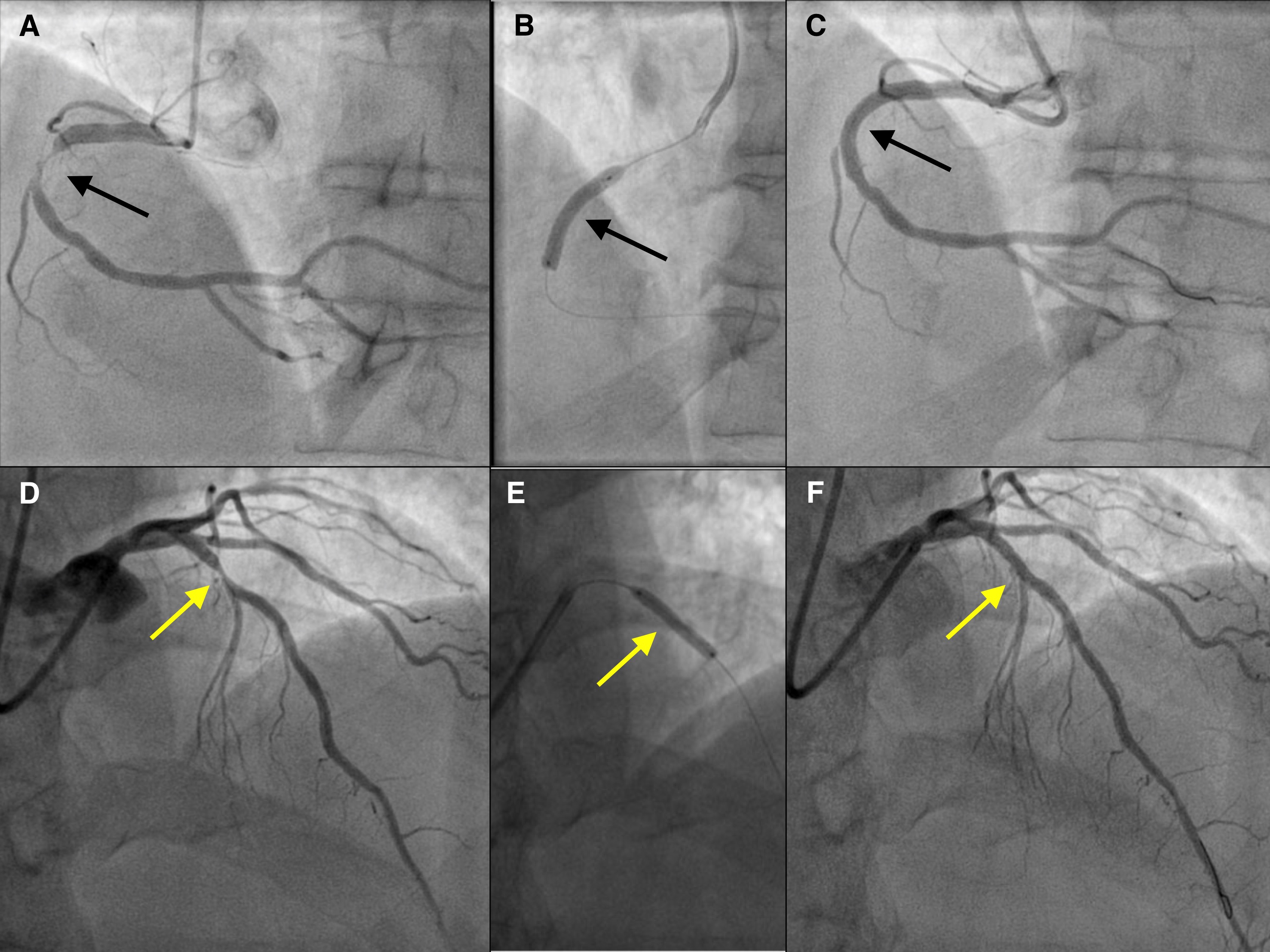 Angioplastia coronaria sobre arteria coronaria derecha y descendente anterior. A) Angiografía de arteria coronaria derecha que muestra lesión severa a nivel medio (flecha negra). B) Implante de stent bioabsorbible en zona de lesión (flecha negra). C) Resultado final tras implante de stent bioabsorbible. D) Angiografía de arteria descendente anterior que muestra lesión severa a nivel medio (flecha amarilla). E) Implante de stent bioabsorbible en zona de lesión (flecha amarilla). F) Resultado final tras implante de stent bioabsorbible.