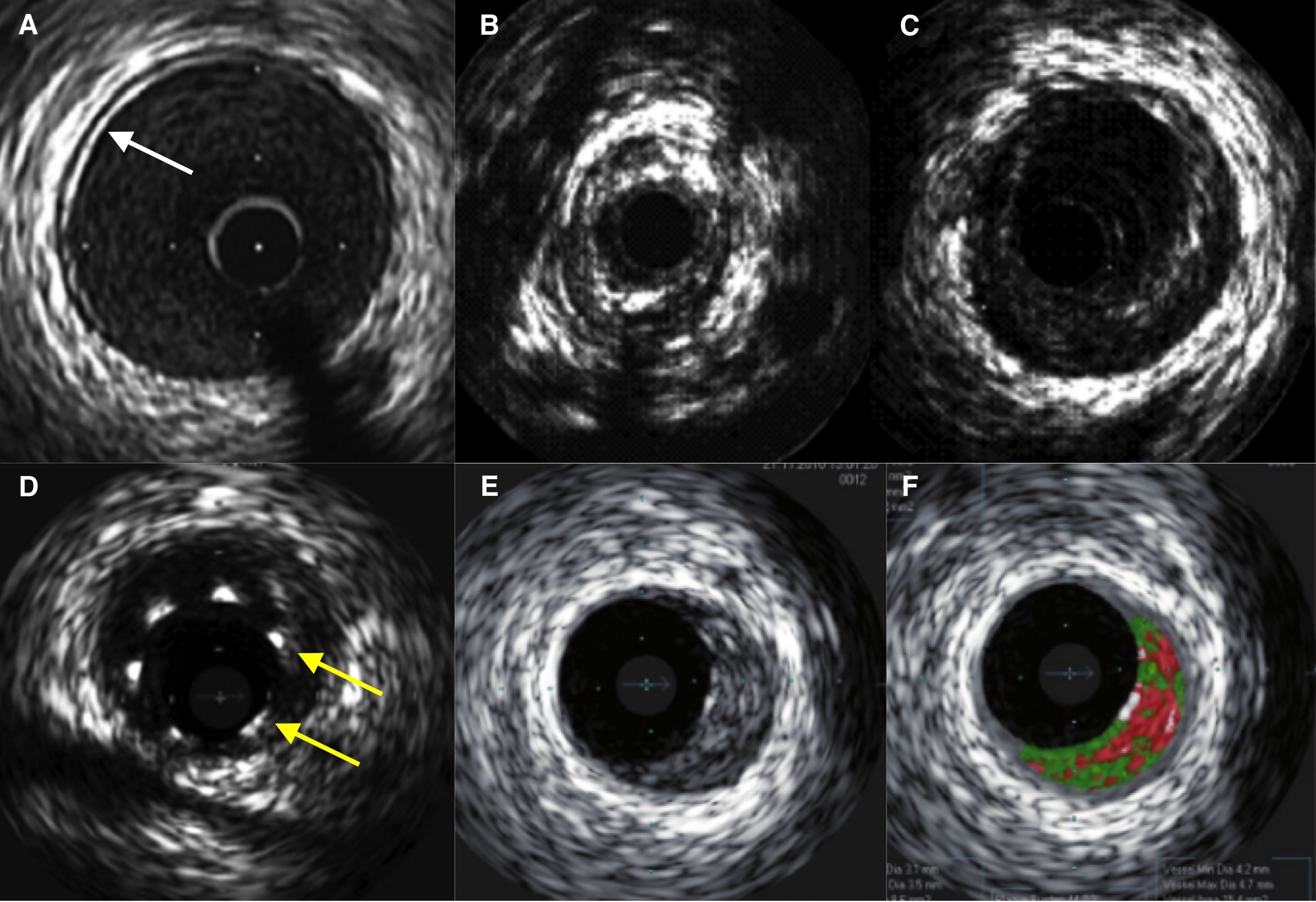 Imágenes ilustrativas de Ecografía intracoronaria o IVUS. A) Arteria coronaria sana visualizada mediante EIC, la flecha blanca señala la capa íntima. B) Placa aterosclerótica lipídica-calcificada severa. C) Placa de composición fibrolipídica blanda. D) Stent con mala posición de patas o struts (flechas amarillas) a la pared del vaso. E y F) Placa lipídica valorada mediante histología virtual.