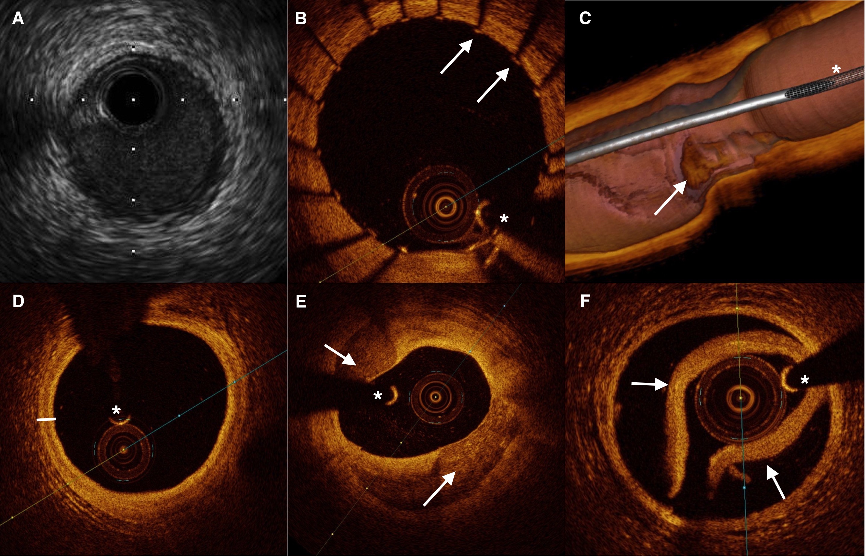 Imágenes ilustrativas de Ecografía Intravascular y Tomografía de Coherencia Óptica. A y D) Corresponden a la misma arteria sana valorada mediante EIC u OCT (línea blanca delimita las 3 capas arteriales: íntima, media y adventicia). B) Stent metálico recién implantado con patas o struts (flechas blancas) bien aposicionados en la pared arterial. C) Reconstrucción 3D de placa erosionada con trombo adherido (flecha blanca). E) Placa calcificada (flechas blancas señalan los cristales de calcio de menor intensidad).  F) Disección arterial coronaria (flechas blancas indican la capa intima-media que se ha separado de la media-adventicia). *Artefacto de la guía coronaria.