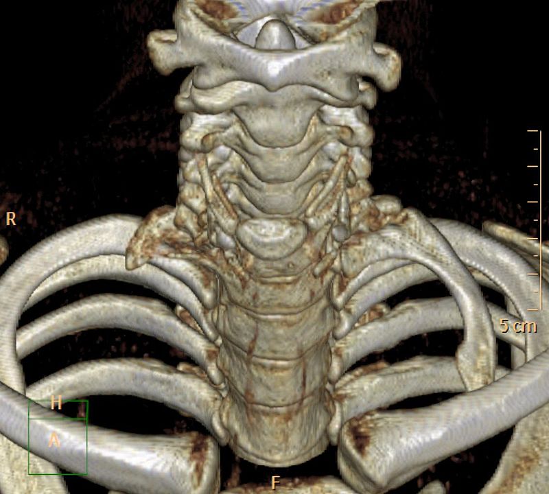 Reconstrucción mediante técnicas de tecnología 3D de una costilla cervical izquierda.