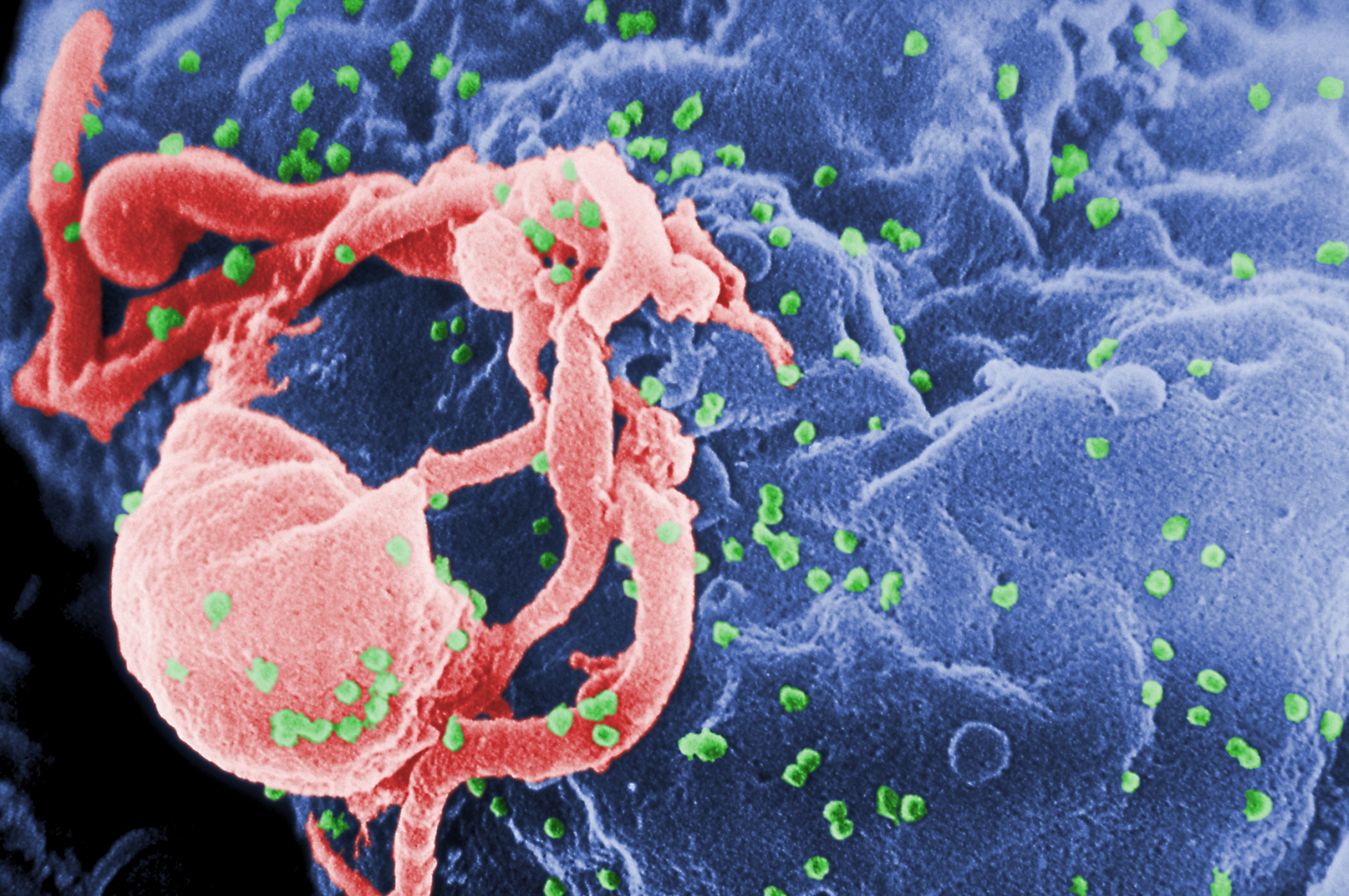 El SIDA es una enfermedad de transmisión sexual que se propaga a través de determinados líquidos corporales (fluidos sexuales o sangre) y ataca el sistema inmunitario del cuerpo, dejándonos expuesto a las enfermedades. En esta microfotograra se aprecia al Virus de la Inmunodeficiencia Humana 1 (VIH-1) en liberación (en verde) en un cultivo de linfocitos.
