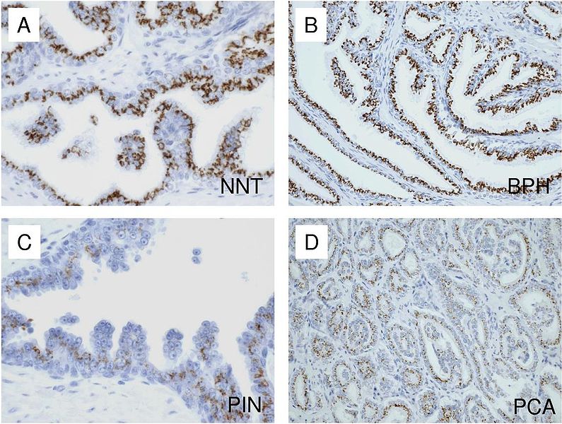 Expresión inmunohistoquímica de p501s en epitelio benigno y maligno de próstata. A) Tejido no-neoplásico prostático adyacente a glándulas malignas (NNT). B) Hiperplasia benigna prostática. C) Neoplasia intraepitelial prostática de alto grado. D) Adenocarcinoma prostático. Autores: Ming Yin, Rajiv Dhir y Anil V Parwani.