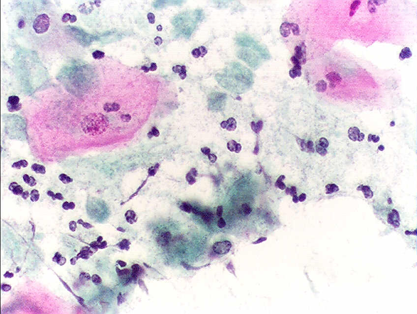 Tinción de Papanicolau de una muestra infectada por Trichomonas vaginalis.