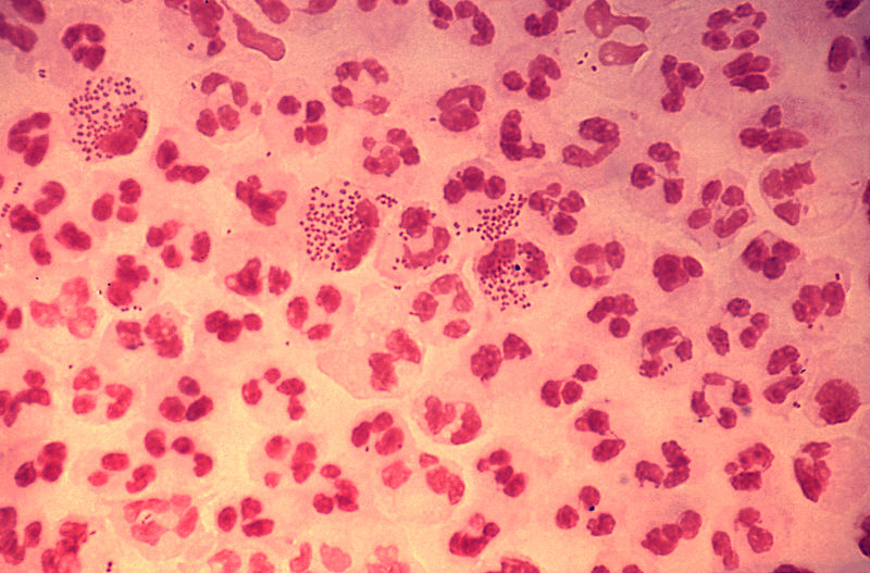 infección gonocócica (gonorrea) por Neisseria gonorrhoeae vista al microscopio óptico. Se puede ver a las bacterias causantes de la infección como diplococos creciendo dentro de dos glóbulos blancos. Las manifestaciones principales de la gonorrea son una secreción purulenta a través de la uretra y la infertilidad femenina.