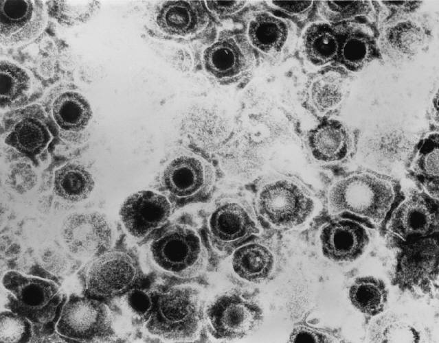 Microfotografía electrónica de transmisión (TEM) del Virus del Herpes Simplex (HSV) causante del Herpes. En la imagen podemos ver algunas cápsidas llenas (más densas) y otras vacías.
Fuente: CDC