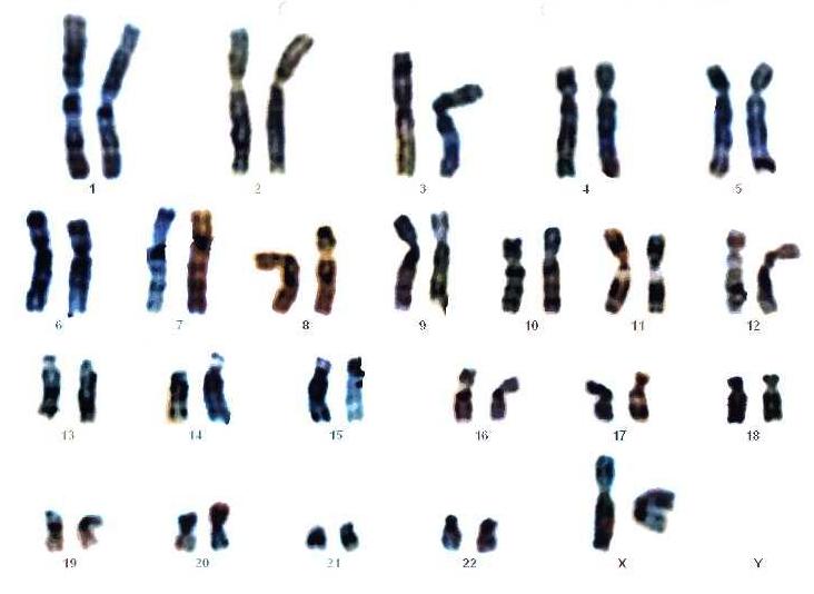 Cariotipo. Mapa citogenético, resultado de una amniocentesis. Es una niña ya que hay dos cromosomas X.