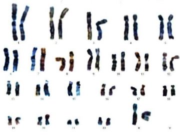 Cariotipo. Mapa citogenético, resultado de una amniocentesis. Es una niña ya que hay dos cromosomas X.