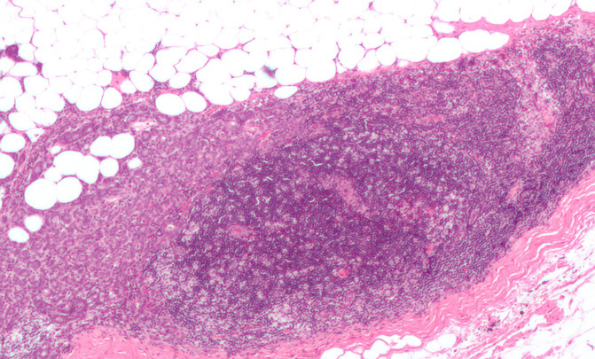 cáncer de mama carcinoma
