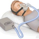 Máquina CPAP (por PruebasBMA/Wikipedia)