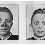 Paciente con lupus sometido a fototerapia, antes y después del tratamiento. Die Bekämpfung des Lupus vulgaris (Jena, 1903)