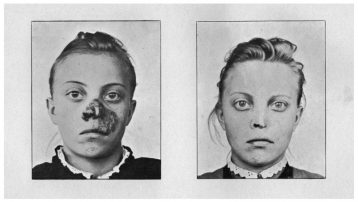 Paciente con lupus sometido a fototerapia, antes y después del tratamiento. Die Bekämpfung des Lupus vulgaris (Jena, 1903)