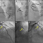 Técnica de imagen intracoronario - Angioplastia coronaria sobre arteria coronaria derecha y descendente anterior. A) Angiografía de arteria coronaria derecha que muestra lesión severa a nivel medio (flecha negra). B) Implante de stent bioabsorbible en zona de lesión (flecha negra). C) Resultado final tras implante de stent bioabsorbible. D) Angiografía de arteria descendente anterior que muestra lesión severa a nivel medio (flecha amarilla). E) Implante de stent bioabsorbible en zona de lesión (flecha amarilla). F) Resultado final tras implante de stent bioabsorbible.