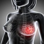 La disminución de la mortalidad como consecuencia del cáncer de mama, después de una tendencia a la baja, se ha estancado.
