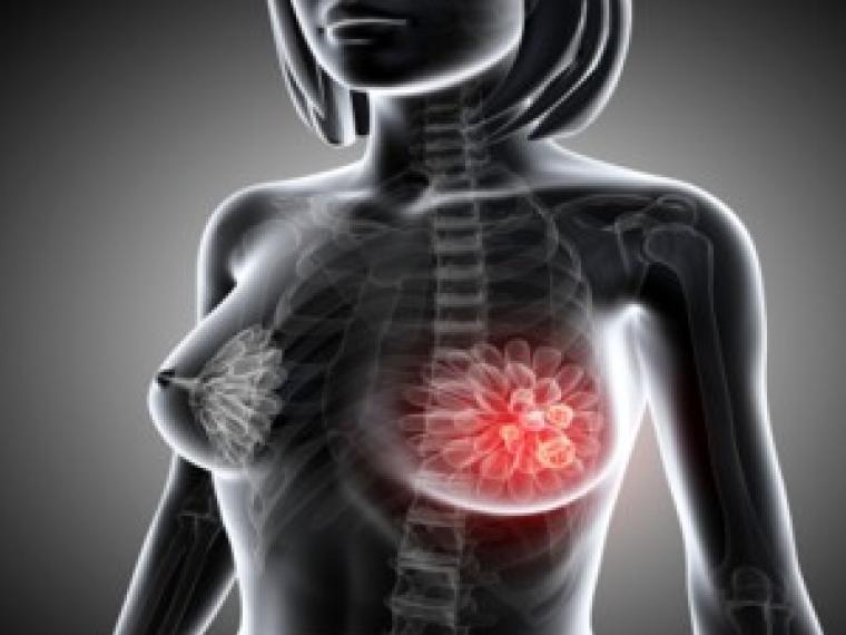 La disminución de la mortalidad como consecuencia del cáncer de mama, después de una tendencia a la baja, se ha estancado.
