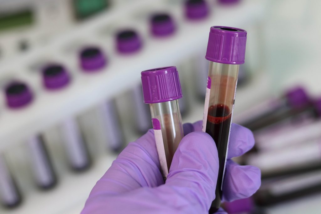 Sangre aislada en el laboratorio con el fin de obtener las células dendríticas tolerogénicas