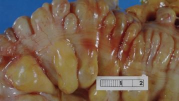 Intestino grueso con múltiples divertículos