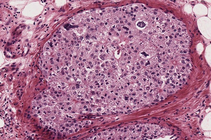 Carcinoma ductal in situ (CDIS). Se encuentran células anormales en el revestimiento de un conducto de la mama.