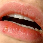 La úlcera con ampollas, característica del herpes labial, es síntoma de la activación del virus del herpes simple tipo I.