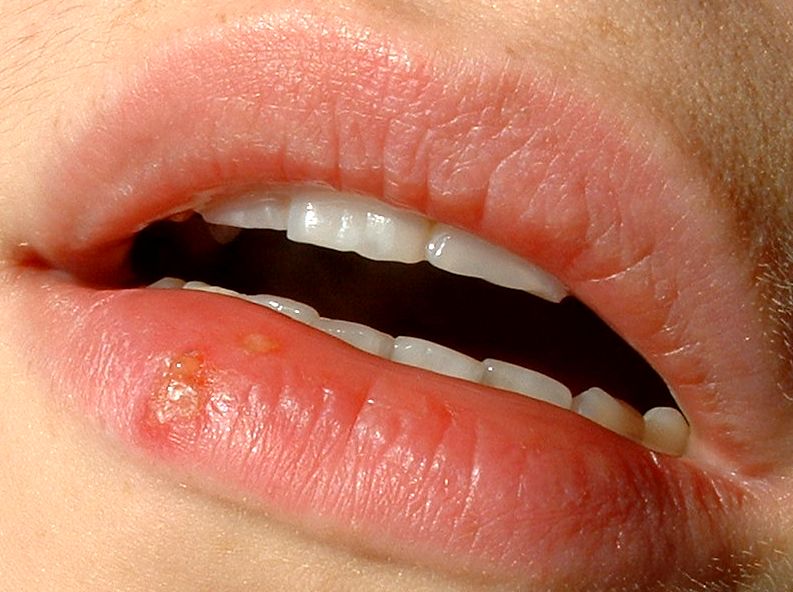 La úlcera con ampollas, característica del herpes labial, es síntoma de la activación del virus del herpes simple tipo I.
