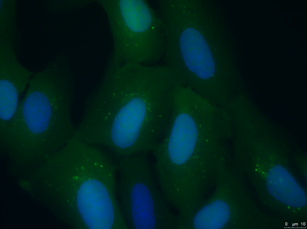 Células de un tumor humano con un marcador fluorescente de autofagia. Las punteaduras verdes brillantes en la célula son autofagosomas.