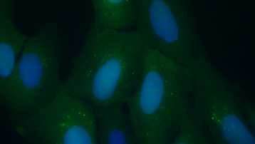 Células de un tumor humano con un marcador fluorescente de autofagia. Las punteaduras verdes brillantes en la célula son autofagosomas.