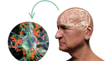 Estudio de las proteínas beta-amiloides como moléculas del sistema inmune que atacan por error a las células cerebrales.