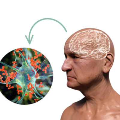 Estudio de las proteínas beta-amiloides como moléculas del sistema inmune que atacan por error a las células cerebrales. Estudio de las proteínas beta-amiloides como moléculas del sistema inmune que atacan por error a las células cerebrales.