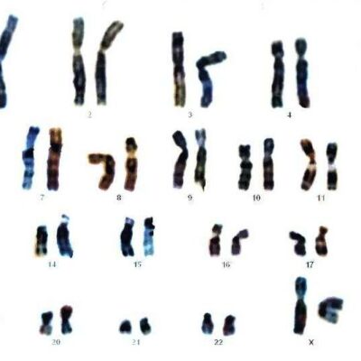 Cariotipo. Mapa citogenético, resultado de una amniocentesis. Es una niña ya que hay dos cromosomas X.