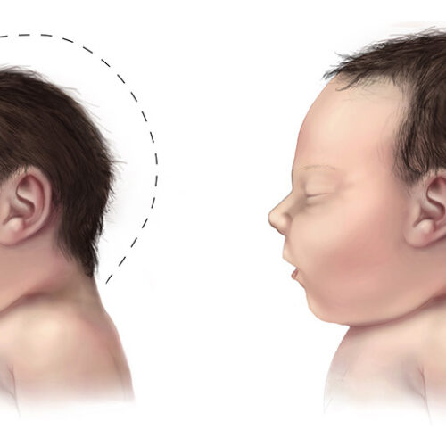 Microcephaly-comparison-500px